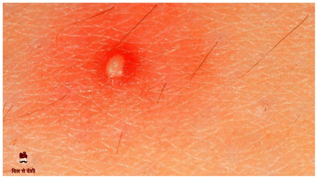 Baltod ke Gharelu Upay in Hindi