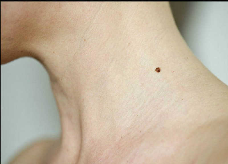 body-mole-tells-about-personality