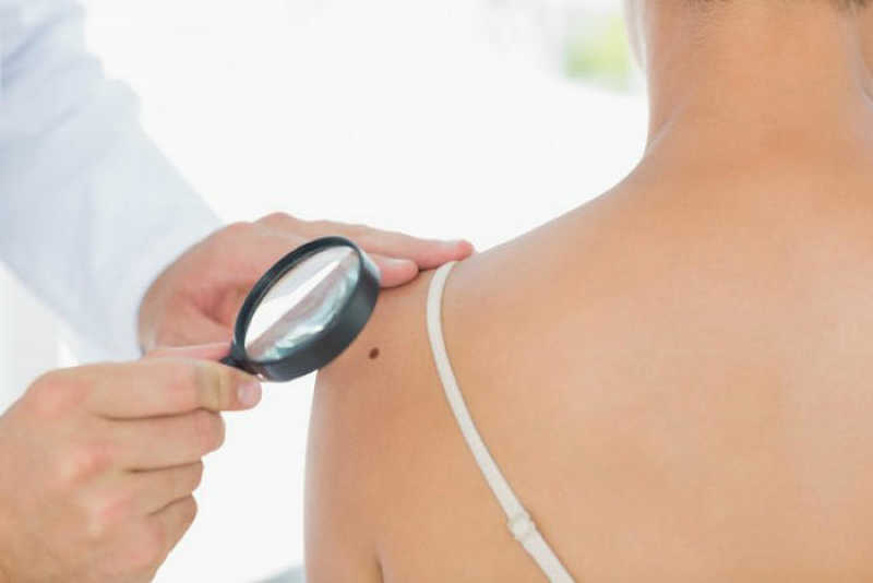 body-mole-tells-about-personality