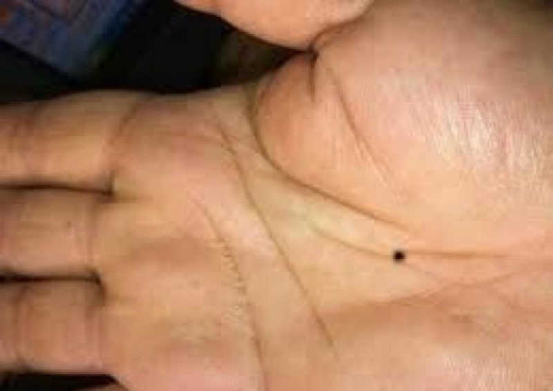 body-mole-tells-about-personality