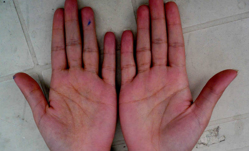 what your palm tells about your health